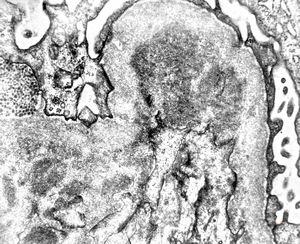 F,28y. | type III membranoproliferative glomerulonephritis